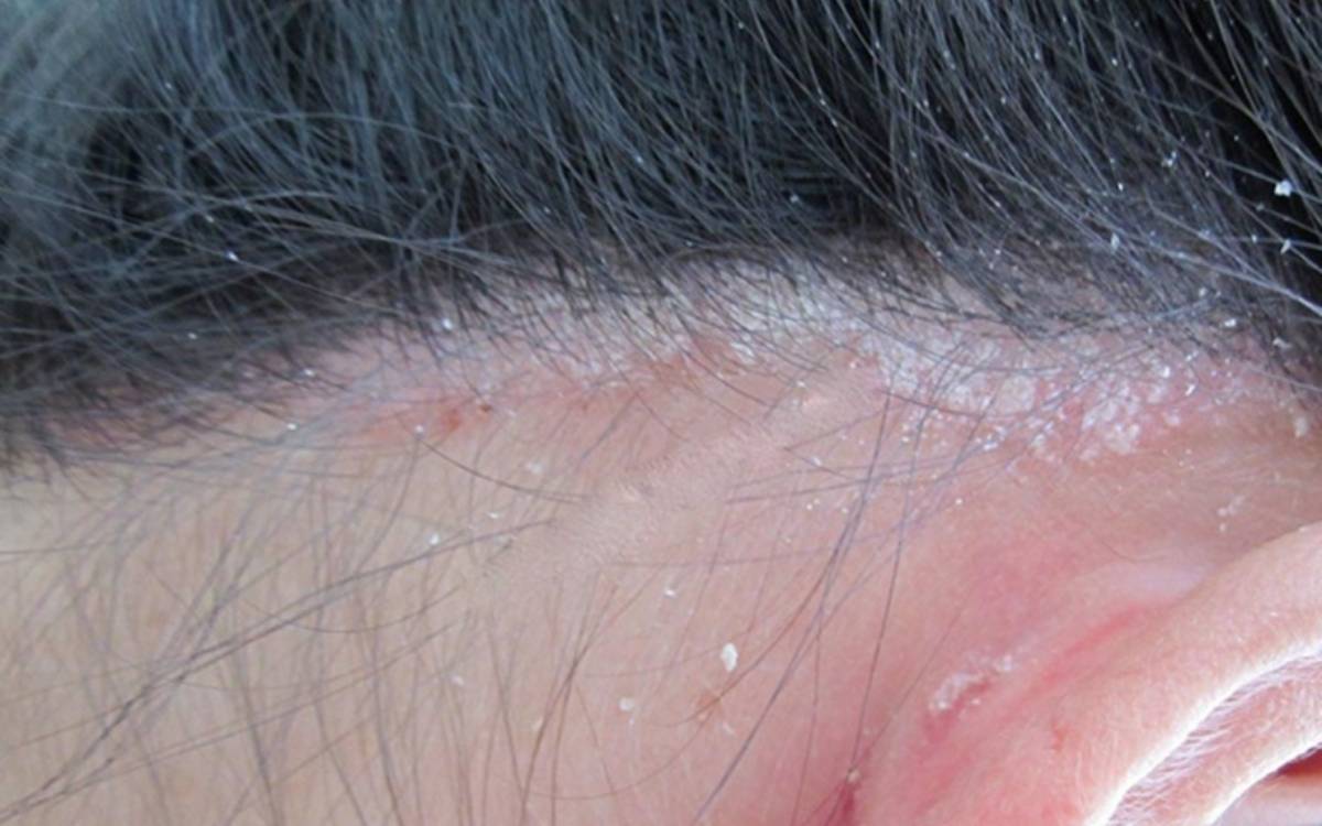 Bong tróc da đầu là dấu hiệu cho thấy tình trạng da đầu của bạn đang không tốt