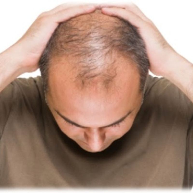 Hói đầu là nỗi sợ của nhiều người