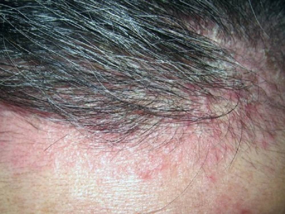 Những bệnh lý về da đầu khiến tóc bạn rụng nhanh chóng