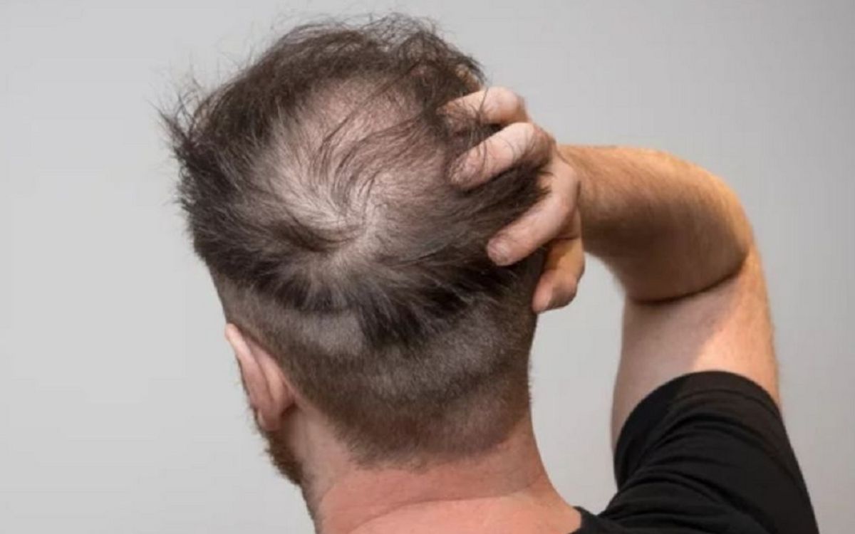 Rụng tóc không chỉ là vấn đề của nữ giới