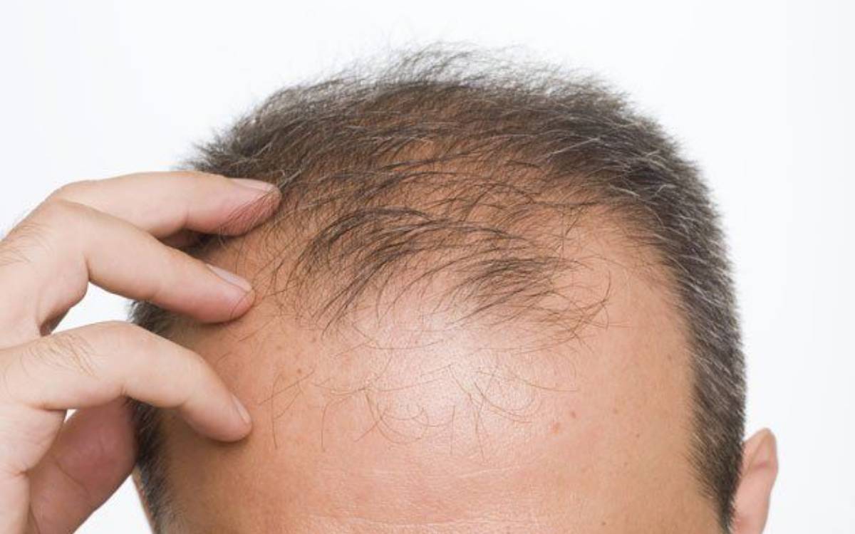 Rụng tóc sớm ở nam giới là một vấn đề không ít người mắc phải