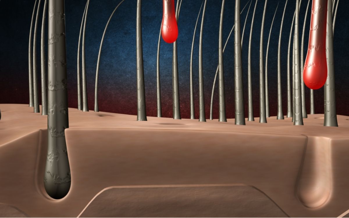 Spiderma Spicule giúp tái tạo các vùng nang tóc bị tổn thương
