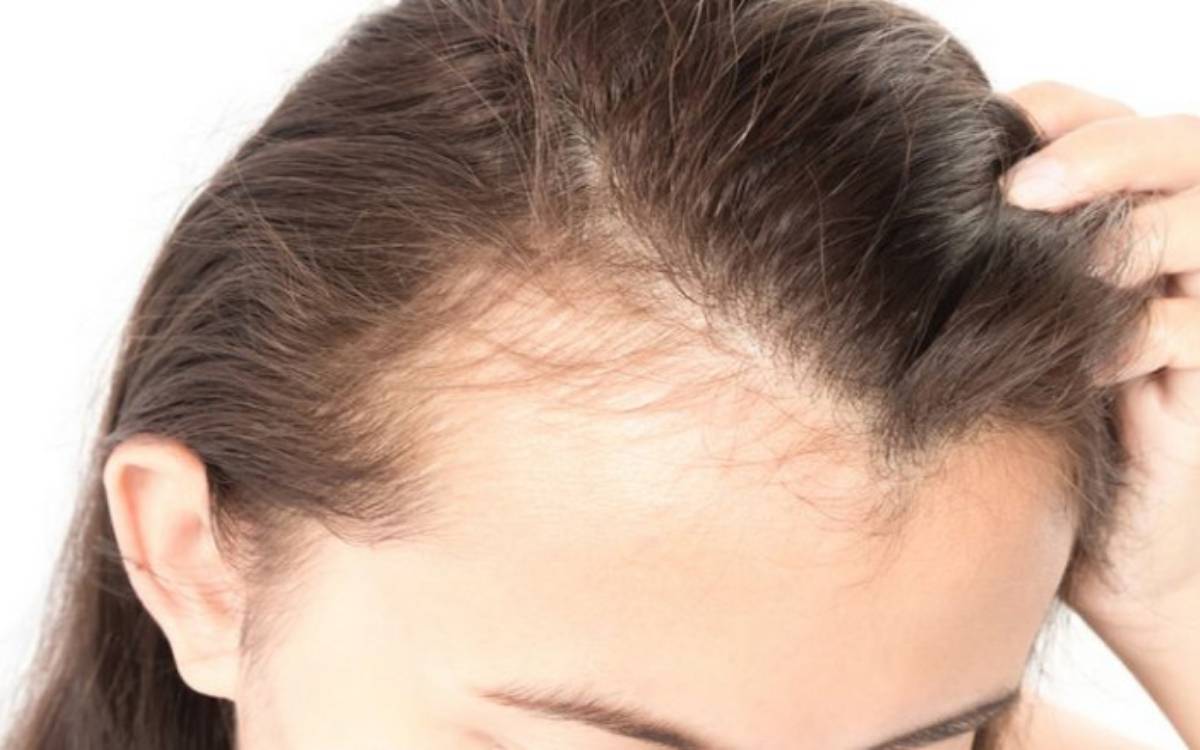 Stress nhiều có thể dẫn đến rụng tóc