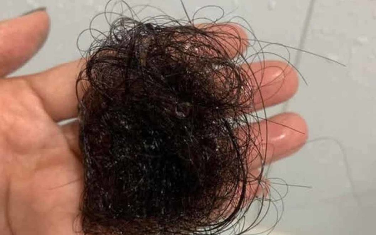 Tình trạng ban đầu rụng tóc rất nhiều