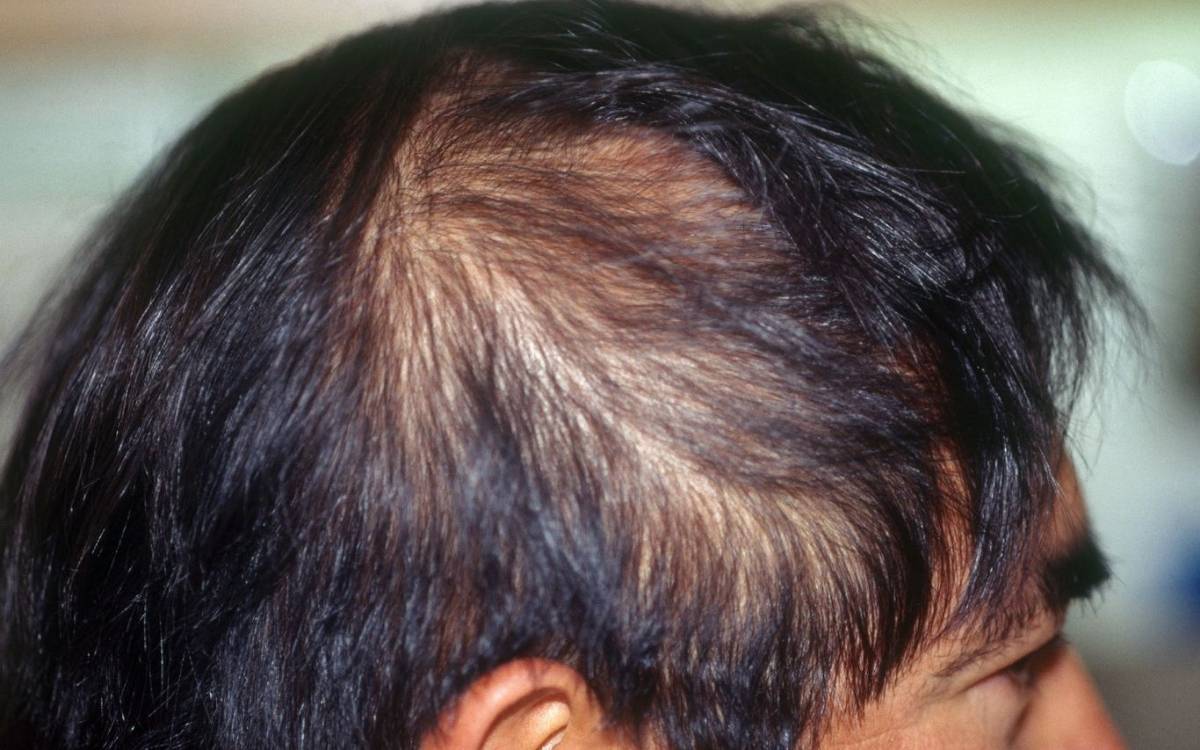 Tóc mỏng đôi khi cũng do yếu tố bẩm sinh