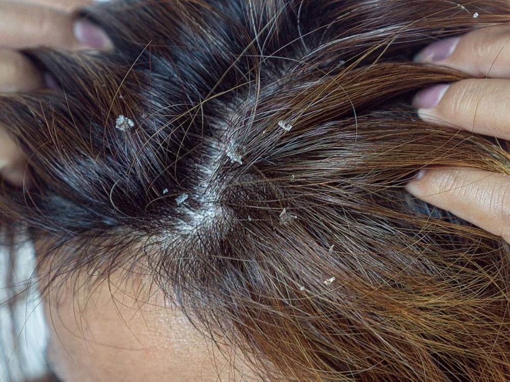 Tẩy da chết cho da đầu là một bước quan trọng
